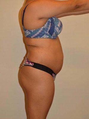 Brazilian Butt Lift