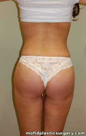 Buttock Implants