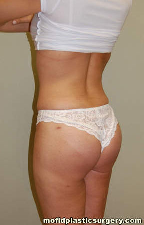 Buttock Implants