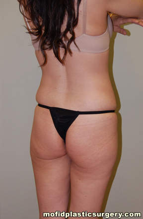 Buttock Implants