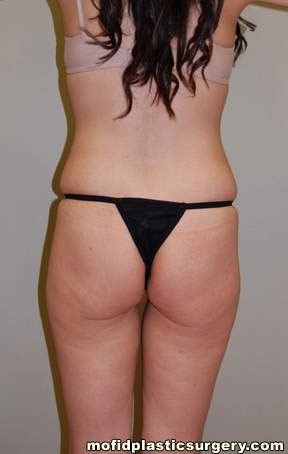 Buttock Implants