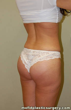 Buttock Implants