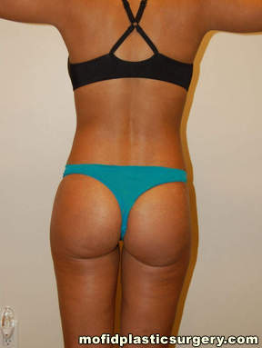 Buttock Implants