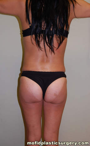 Buttock Implants