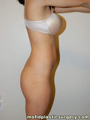 Buttock Implants