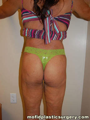 Buttock Implants